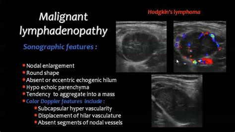 Pin by Dr abuaiad on lymphatics | Diagnostic medical sonography ...