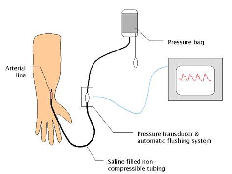 Arterial blood pressure measurement. An intra-arterial catheter (aka ...