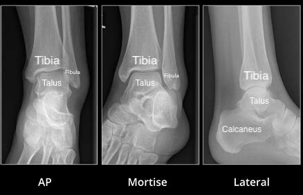 Talus Contusion