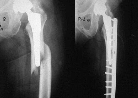 THA Periprosthetic Fracture - Recon - Orthobullets