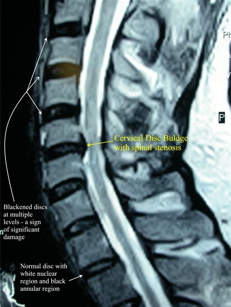 Cervical Disc Herniations | Dr. Russell D. Caram Chiropractor