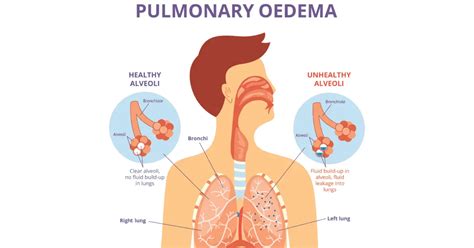 Fluid Filled Lungs; Causes And Treatment | Inspire Blog