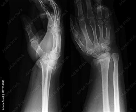 X-ray photos of hand bone fracture patients Stock Photo | Adobe Stock