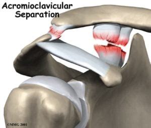 AC Separations- When is Surgery Considered? Video Discussion. – Howard ...