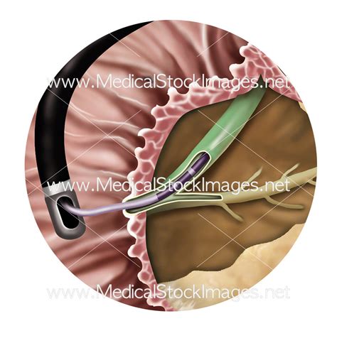 Endoscopic Retrograde Cholangiopancreatography or ERCP – Medical Stock ...