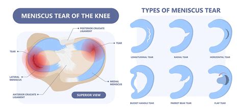 Top Causes of Torn Meniscus and How to Treat It | Vejthani