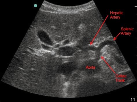 Celiac trunk ultrasound anatomy