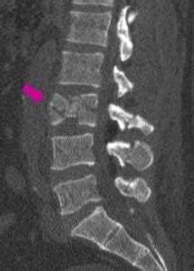 L3 Fracture - Texas Minimally Invasive Spine Surgery | Dr. Shaad Bidiwala