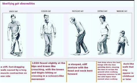 Gait Abnormalities Gait abnormality is a...