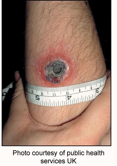 Figure 3 - Bioterrorism-Related Anthrax: International Response by the ...