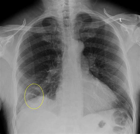 Cureus | Cavitary Pulmonary Infarction in a Case of Pulmonary Embolism ...