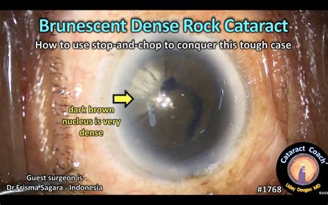 brunescent cataract – Cataract Coach™