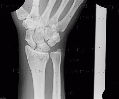 Radiology case: Wrist, normal x-ray