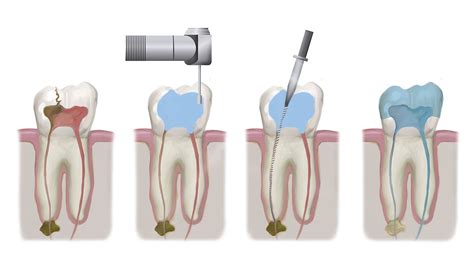 How Long Does Root Canal Therapy Take? - Birmingham, AL