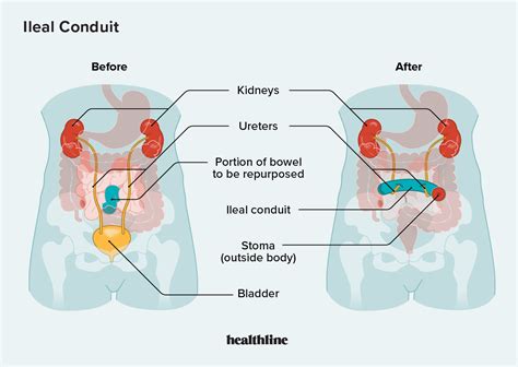 Types Of Urinary Diversion Procedures Ileal Conduit:, 56% OFF