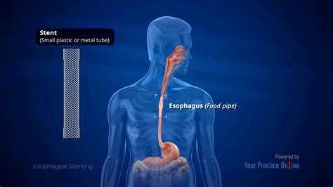 Esophageal Stenting Video | Medical Video Library