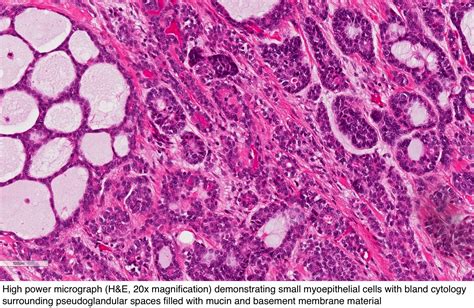 Mucoepidermoid Carcinoma Of Parotid Gland