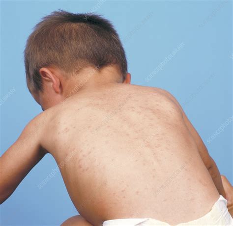 Measles rash - Stock Image - M210/0222 - Science Photo Library