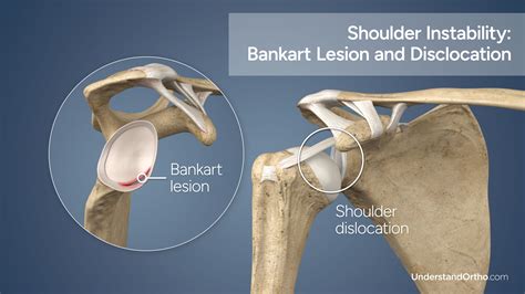 Bankart Repair – UnderstandOrtho™