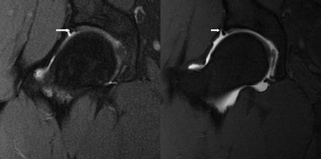 3T MRI as good as MR arthrography for planning hip surgery