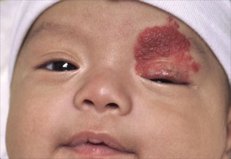 Topical Treatment for Capillary Hemangioma of the Eyelid Using β ...