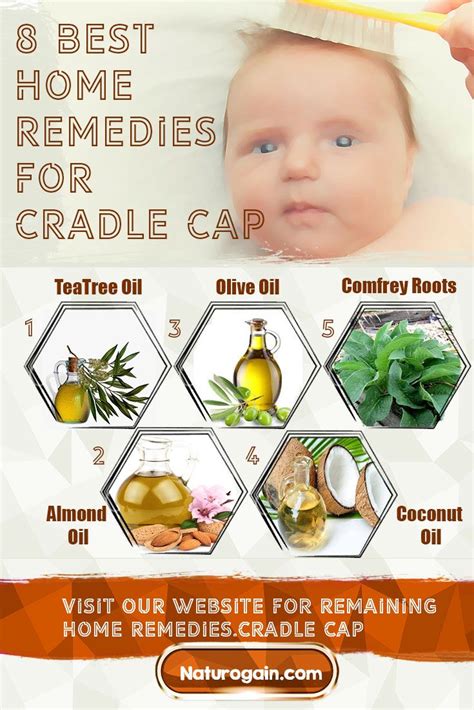 8 Best Home Remedies for Cradle Cap That Work Fast | Cradle cap, Cradle ...