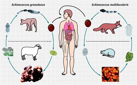 Echinococcosis - MEDizzy