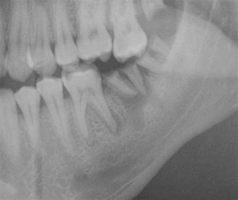 Abscessed Tooth Xray