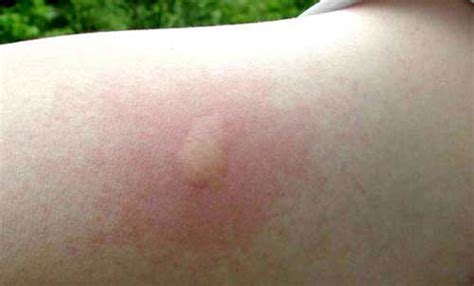 ant bite symptoms - pictures, photos