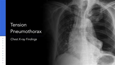 Pneumothorax Chest X Ray Chest X Ray At Presentation Pneumothorax | The ...