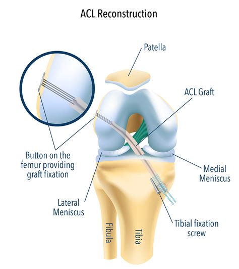 ACL Reconstruction Surgery Melbourne | ACL Repair Surgery Specialist ...