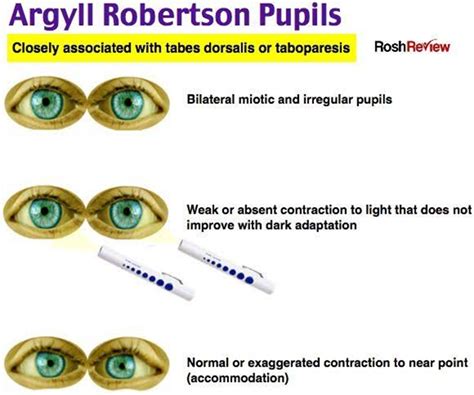 PUPILLARY REFLEXES AND THEIR ABNORMALITIES - Optography