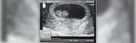 Ultrasound imaging for endometrial hyperplasia | Women's Health ...