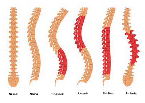 Scoliosis - ONZ Spine