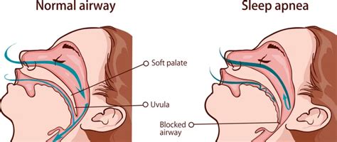 Is Sleep Apnea A Serious Condition? - Dentists in Nixa, MO