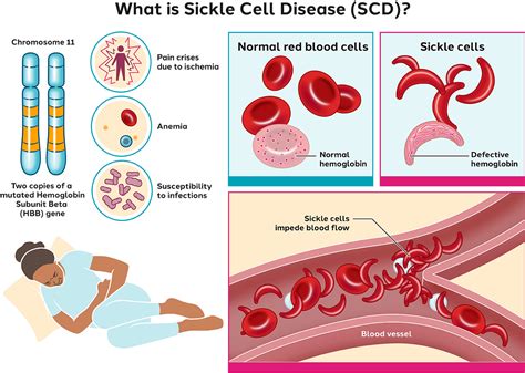 Sickle Cell Anemia Mutation