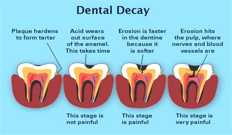 #Dental #Decay their causes and impact! | Dental decay, Dental, Dentistry