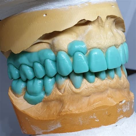 Wax-up Делаем мир улыбчивей… | Dental art, Dental anatomy, Dental ...