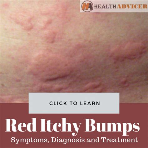 Red Itchy Bumps On Skin Causes Treatment Pictures Minhhai2d Help ...