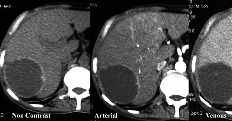 Radiodiagnosis - Imaging is Amazing-Interesting cases: Hydatid cyst of ...