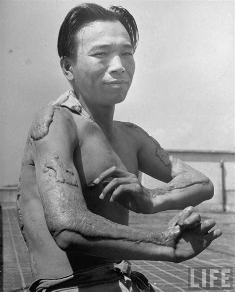 A survivor still hospitalized in Hiroshima showing arms and torso ...