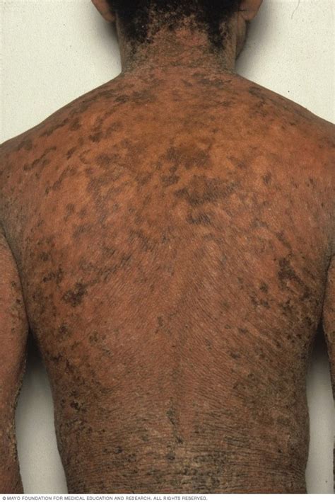 Ichthyosis vulgaris - Symptoms and causes - Mayo Clinic