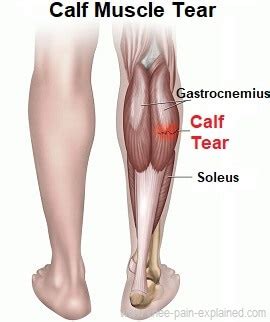 Calf Muscle Tear Treatment - Knee Pain Explained (2023)