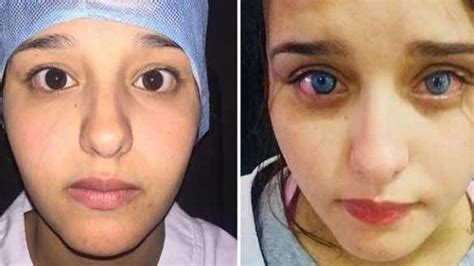 Africa’s First Eye Color Surgery Occurs in Morocco