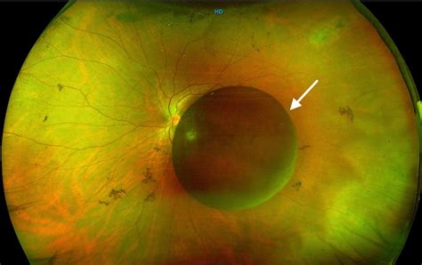 Pigmented iris cyst in vitreous chamber | BMJ Case Reports