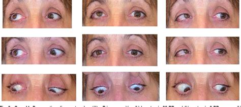 Partial third cranial nerve palsy: clinical characteristics and ...