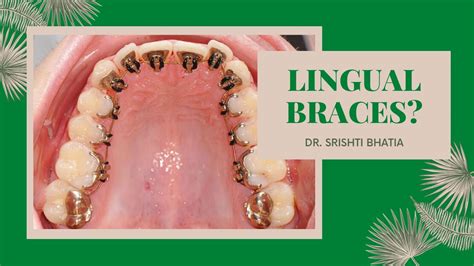 Lingual Braces- Pros, Cons, Process & Cost; Dr. Srishti Bhatia - YouTube