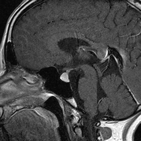 Pituitary hyperplasia | Image | Radiopaedia.org