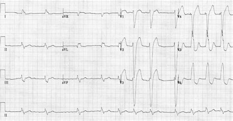 Left Bundle Branch Block Ecg