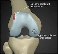 COSM | Knee arthroscopy with repair of cartilage lesion or ...